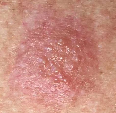 nikkel allergie symptomen